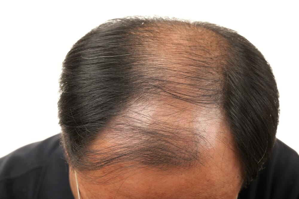 Greffe de cheveux : implants capillaires contre calvitie ...