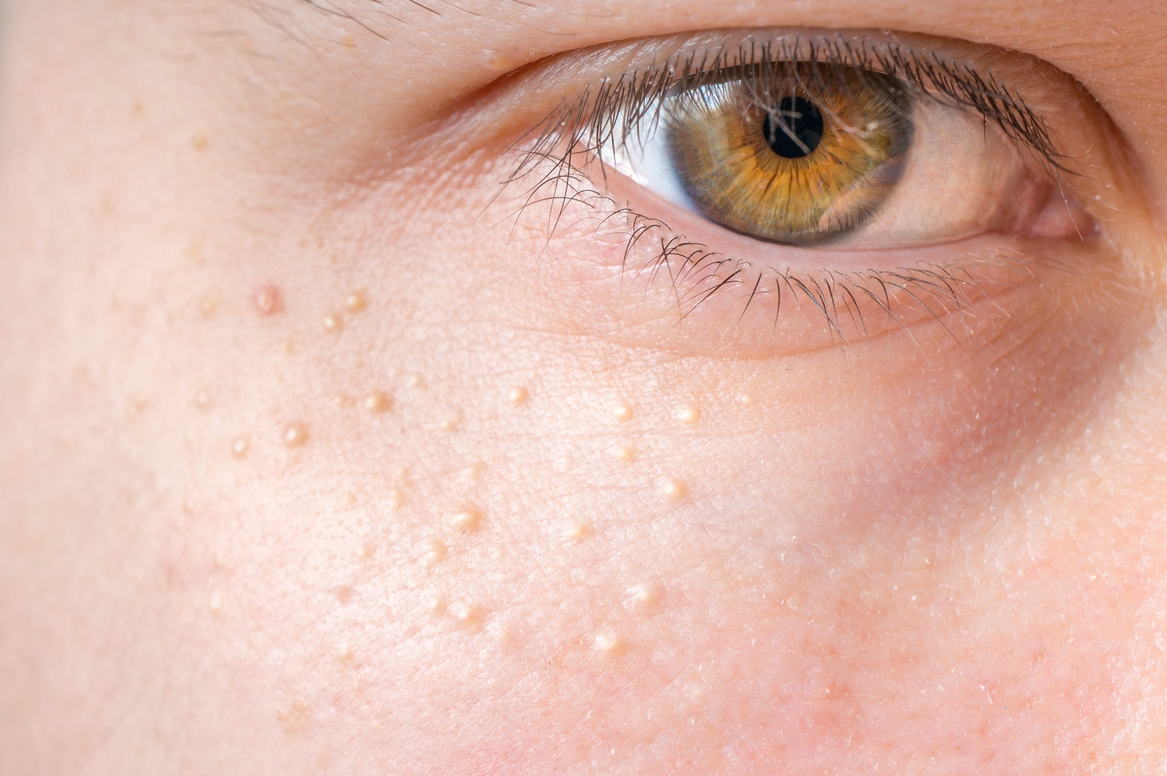 Nos traitements pour effacer une cicatrice d'acné | Clinique du Lac